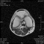 Определение проблемы по МРТ коленного сустава при пересылке по электронке фото 1