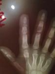 Перелом пальца руки фото 1