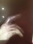 Перелом пальца руки фото 2