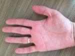 Постоянные боли в пальцах рук (кончики пальцев) фото 2