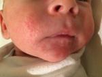 Сыпь на лице, ушах и шее у новорожденного фото 1