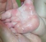 Волдыри на кистях рук и стопах ног у ребёнка фото 4