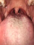 Назофарингит, ощущение кома в носоглотке, в горле фото 1