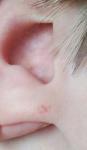 Кровоподтек на мочке уха фото 1