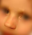 Отек и шишка с одной стороны носа у ребенка фото 2