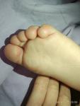Волдыри на кистях рук и стопах ног у ребенка фото 1