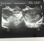 Беременность 2-3 недели фото 2