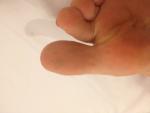 Сыпь на пальце ноги фото 1