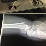 Перелом руки на рентгене фото 1