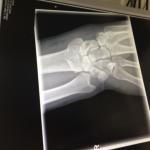 Перелом руки на рентгене фото 2