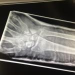 Перелом руки на рентгене фото 3