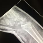 Перелом руки на рентгене фото 4
