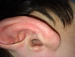 Воспаления уха фото 1
