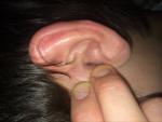 Воспаления уха фото 2