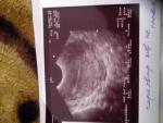 Внематочная, замершая беременность или же эндометриоз фото 3
