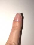 Подногтевая меланома чёрная полоска на ногте фото 2