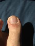 Красная точечная сыпь на пальце ноги фото 1