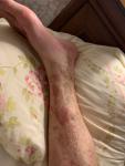 Сыпь на ногах, иногда чешется, варикоз или грибковое, был тромбофлебит фото 1