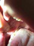 Афтозный стоматит язвы во рту фото 2