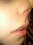 Красная сыпь возле рта и носа фото 1