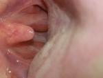 Ком в горле: есть ли воспаление по бокам в горле? фото 2