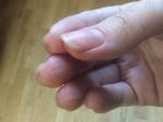 Потемнение кожи вокруг ногтей на руках фото 2