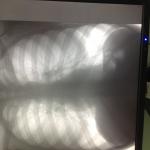 Белые пятна на флюорографии фото 2