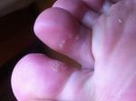Сыпь между пальцев ног фото 1