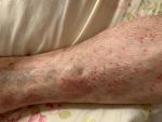 Сыпь на ногах, иногда чешется, варикоз или грибковое, был тромбофлебит фото 2