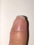 Подногтевая меланома чёрная полоска на ногте фото 3