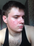Акне, очень жирная кожа(парень 19 лет) фото 2