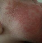 Сыпь на лице у месячного ребенка фото 1