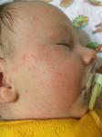 У новорожденного 1,5 месяца аллергический дерматит фото 1