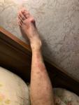 Сыпь на ногах, иногда чешется, варикоз или грибковое, был тромбофлебит фото 3