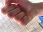Покраснение пальцев на сгибе фото 4