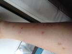 Сыпь на ногах сильно чешется похожа на комариные укусы фото 1