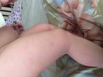 У доченьки 10 месяцев красные пятнах на ножках, которые шелушатся фото 5