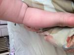 У доченьки 10 месяцев красные пятнах на ножках, которые шелушатся фото 6