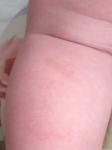 У доченьки 10 месяцев красные пятнах на ножках, которые шелушатся фото 8
