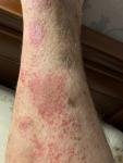 Сыпь на ногах, иногда чешется, варикоз или грибковое, был тромбофлебит фото 4