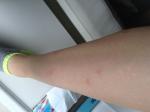 Сыпь на ногах сильно чешется похожа на комариные укусы фото 2