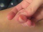 Болезненное уплотнение возле ногтя на пальце руки фото 3