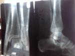 Перелом малоберцовой кости со смещением 6мм фото 1