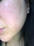 Помогите определить мое заболевание кожи фото 2
