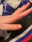 Проблема с кожей на пальцах рук фото 2
