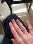 Отек пальце без боли и зуда фото 5