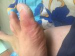 Покраснение больших пальцев ног фото 1