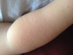Алергия у ребёнка в 1,6 лет фото 2