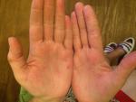 Новообразования на пальцев руки фото 2