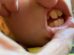Налет на передних верхних коренных зубах у ребенка фото 2